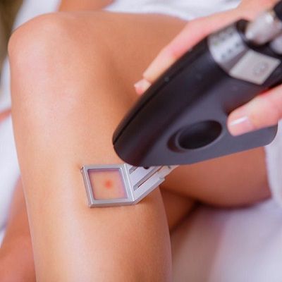 How Often Do you Need Laser Hair Removal