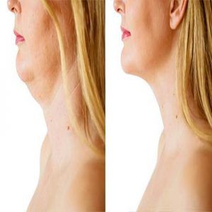 Fat Melting Injections in Dubai, Abu Dhabi & Sharjah | Fat Dissolving