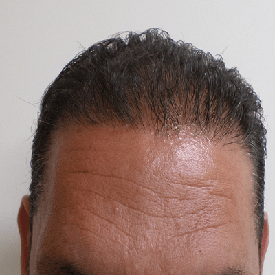 Hair Transplant for Black Males