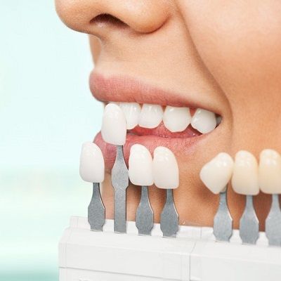 Hydrogen Peroxide Teeth Whitening in Dubai & Abu Dhabi Cost & Offer