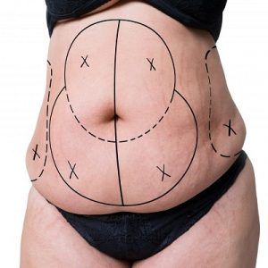 A Complete Guide to Liposuction Surgery in Dubai