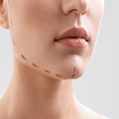 Chin Implant Surgery | Jaw Contouring for Men & Women