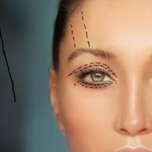 Eyelid Surgery for Thyroid Eye Disease (TED) in Dubai