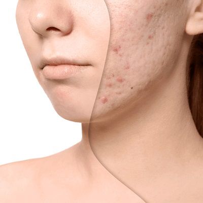Subcision Treatment For Acne Scars Cost