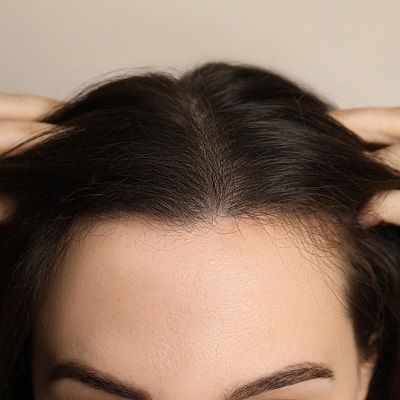 Hair Transplant For Women’s Hair Loss