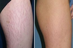 Stretch Mark Removal, Before and After