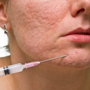 Dermal Fillers for Effective Acne Scar Treatment