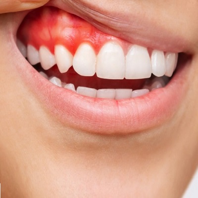 Gingival Recession Causes And Treatment