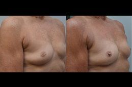 Nipple correction - o2 Clinic