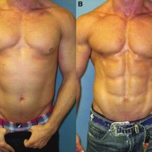 Gynecomastia Surgery for Bodybuilders in Dubai