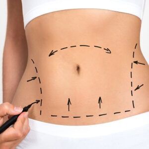 Does Liposuction Remove Cellulite From Your Body?