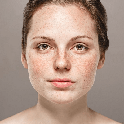 The Best Dermal Pigmentation Treatment Options for Your Skin Type