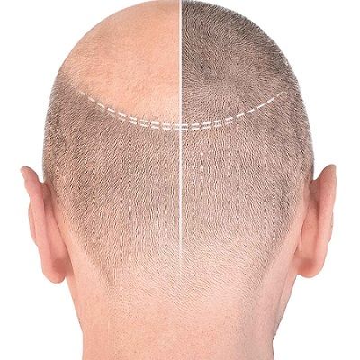 DHI Hair Transplant for Hair Loss