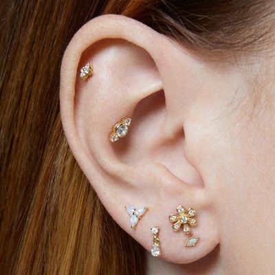 Ear Pinning Without Surgery A Guide To Success