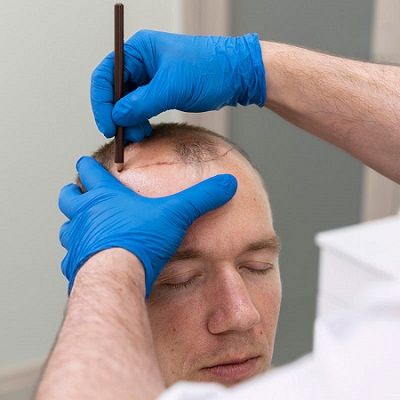 Bio-Enhanced FUE Hair Transplant, A Revolutionary Method