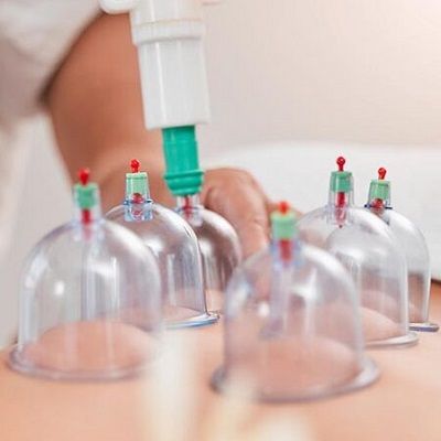 Hijama For Weight Loss In Dubai – 5 Ways How It Works