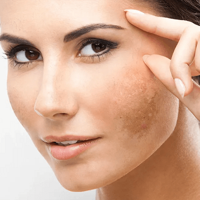 Addressing Melasma with Fractional CO2 Laser