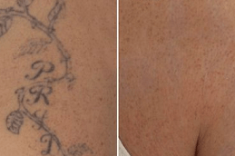 Before and After Laser Tattoo Removal