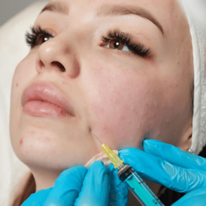 Can Dermal Fillers Help to Fill Acne Scars?