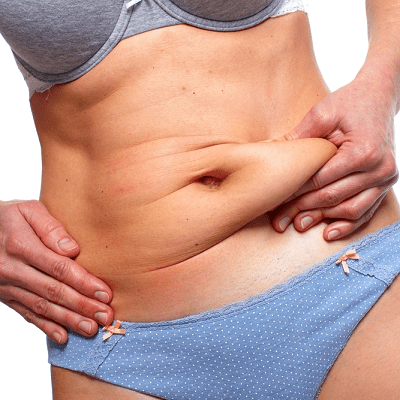 Can Tummy Tuck Remove Belly Fat?