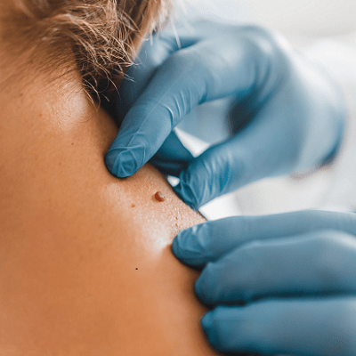 Eliminating Skin Tags with Fotona Laser Technology