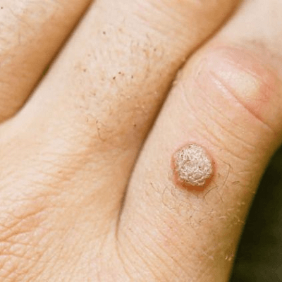 How Salicylic Acid Help in Wart Removal?