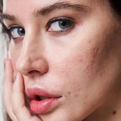 Is Microneedling Good for Acne Scarring?