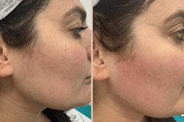 Laser Hair Removal After and Before