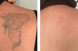 Laser Tattoo Removal After and Before