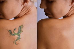 Laser Tattoo Removal Before and After