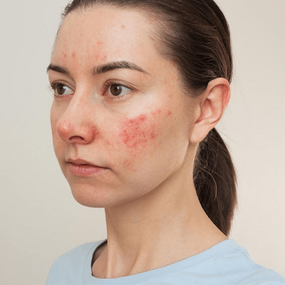 How to Conceal Rosacea on the Face?