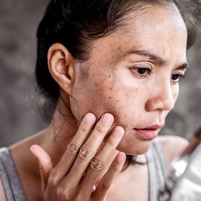 What Causes Skin Pigmentation and can it be Treated?