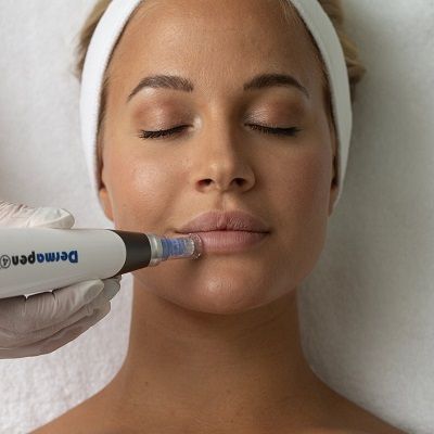 Dermapen Treatment for Minimising Pores