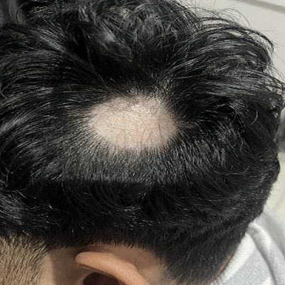 Improve Hair Density with Alopecia Areata Treatment