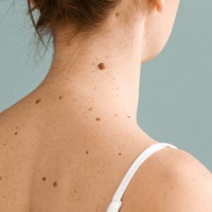 Which Skin Tag Removal works best for Your Skin?