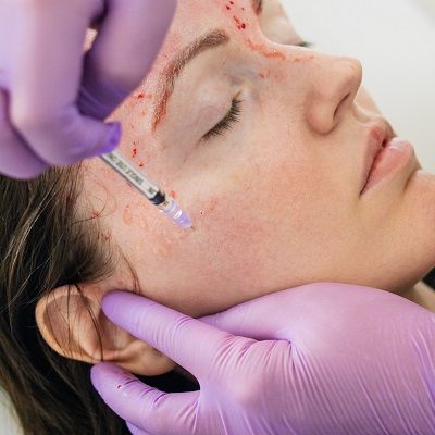 Can a Vampire Facial Make You Look Younger?