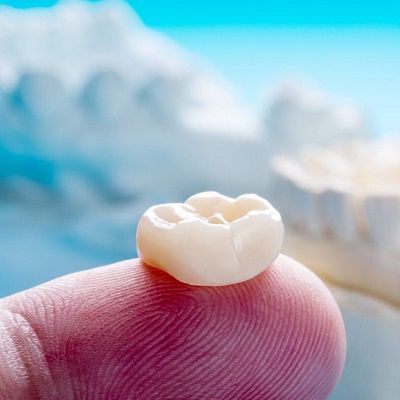 Dental Crowns & Bridges in Dubai