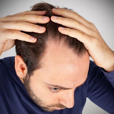 How To Reverse Male Pattern Baldness?