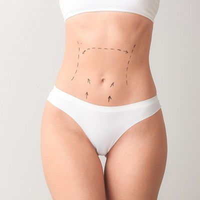 Tummy Tuck Dubai Silicon Oasis