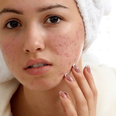 Acne Scar Treatment Dubai Silicon Oasis